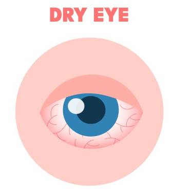 Dry Eye Treatment