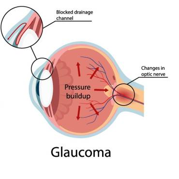 Glaucoma Treatment