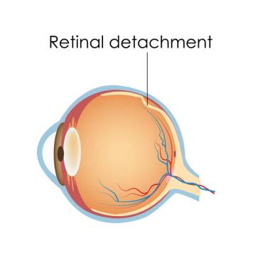 Retinal Detachments & Holes