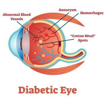 Diabetic Retinopathy Treatment