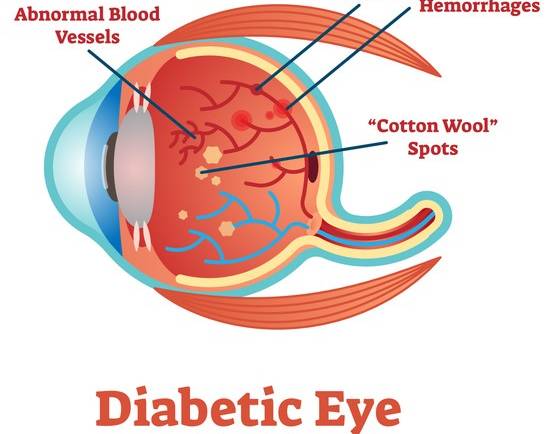 Diabetic Retinopathy Treatment