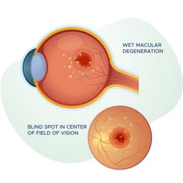 Macular Degeneration Treatment