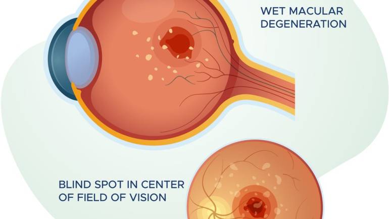 Macular Degeneration Treatment